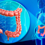 Cáncer de colón