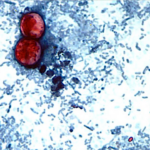 ciclosporiasis