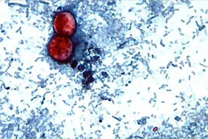 ciclosporiasis
