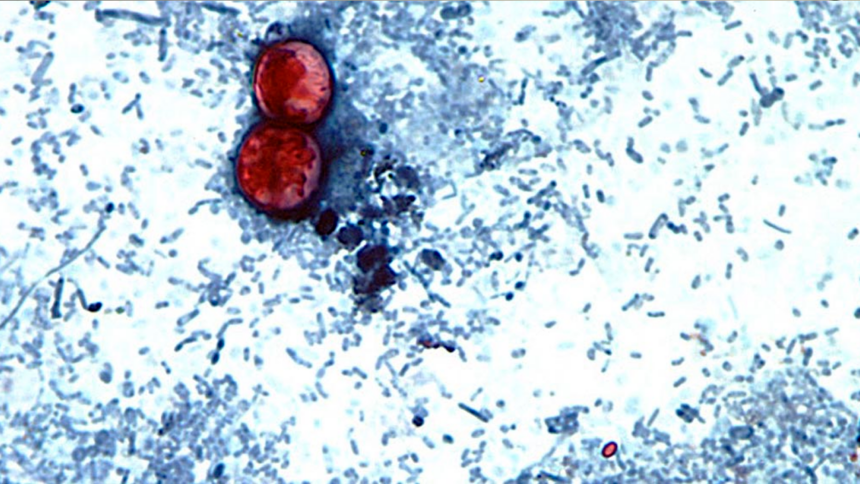 ciclosporiasis